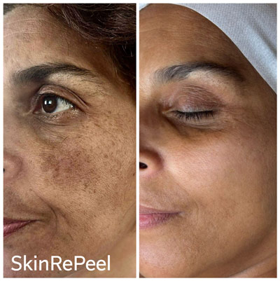 SkinRePeel-Before-After-13 SkinRePeel before after 1