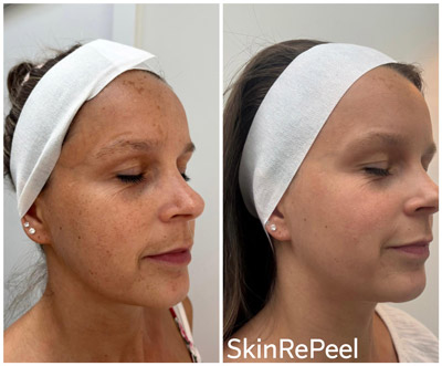 SkinRePeel-Before-After-14 SkinRePeel before after 2