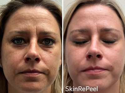 SkinRePeel-Before-After-15 SkinRePeel before after 3